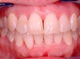 Cosmetic dentistry - 1 after