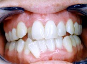 Cosmetic dentistry - 1 before