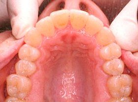 Cosmetic dentistry - 1 after
