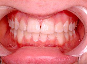 Cosmetic dentistry - 1 after