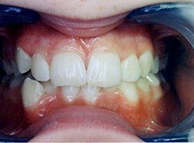 Cosmetic dentistry - 1 before