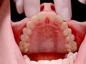 Cosmetic dentistry - 1 after