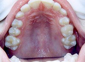 Cosmetic dentistry - 1 before