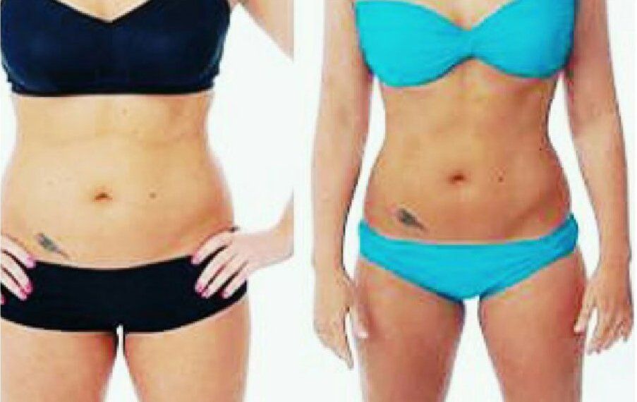 body lift