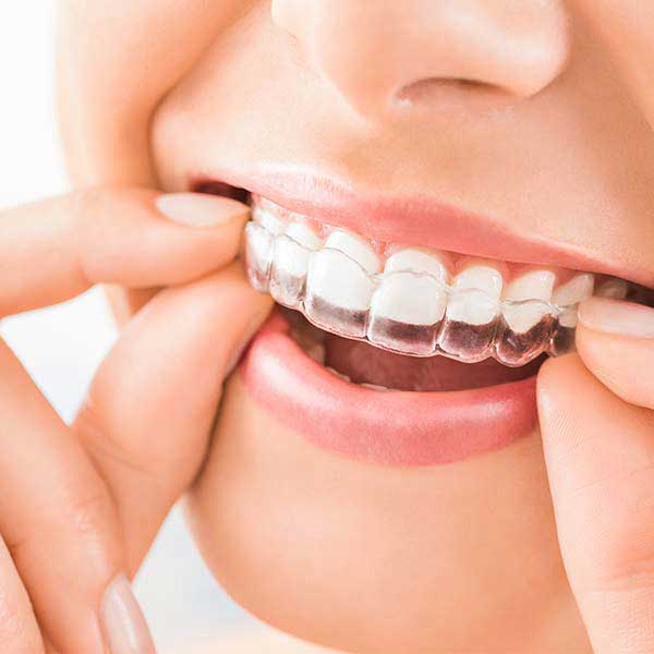 Clear Aligners in Orlando, Florida