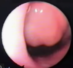 adenoidi