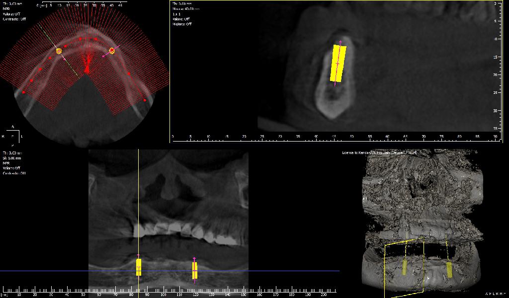 Risultati radiografia dentale
