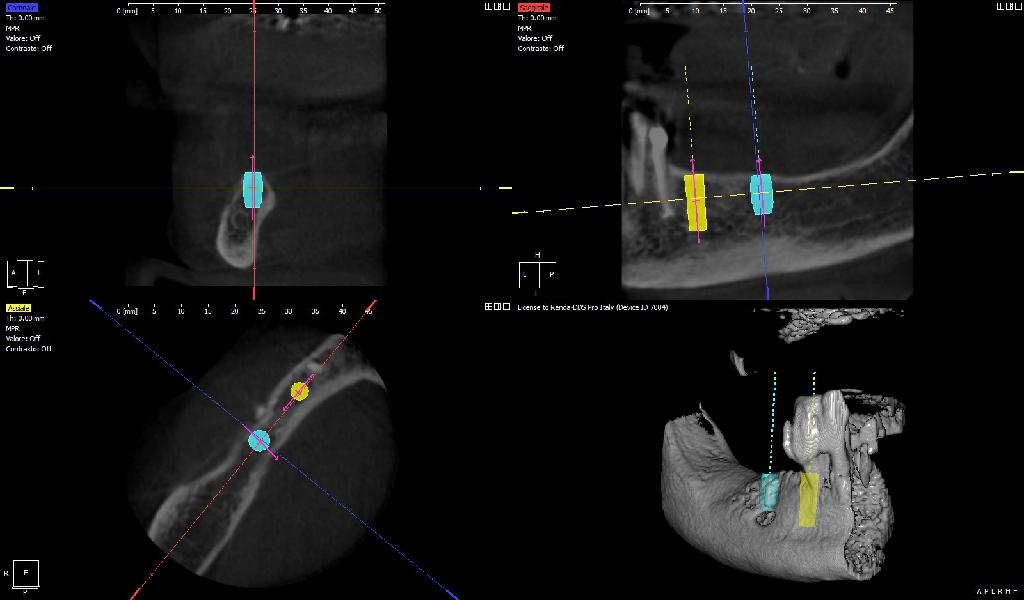 Risultati TAC Cone Beam