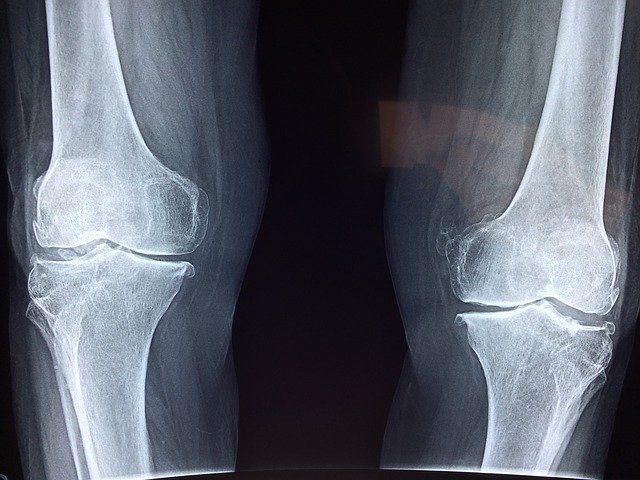 Bone Knee — Redlands, CA — Beloved Foundation