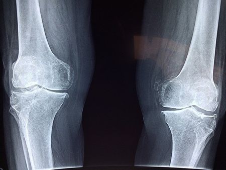Bone Knee — Redlands, CA — Beloved Foundation