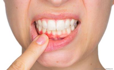 Laser gegen Lippen-Herpes und Aphthen