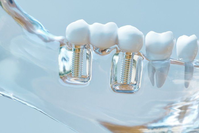 3D Model of Dental Implant — Bloomingdale, IL — Dr Boyer & Scheive, DDS 3D Model of Dental Implant — Bloomingdale, IL — Dr Boyer & Scheive, DDS