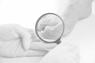Nail Fungus