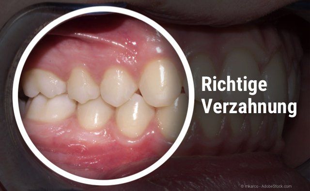 Richtiger Zusammenbiss der Ober- und Unterkieferzähne