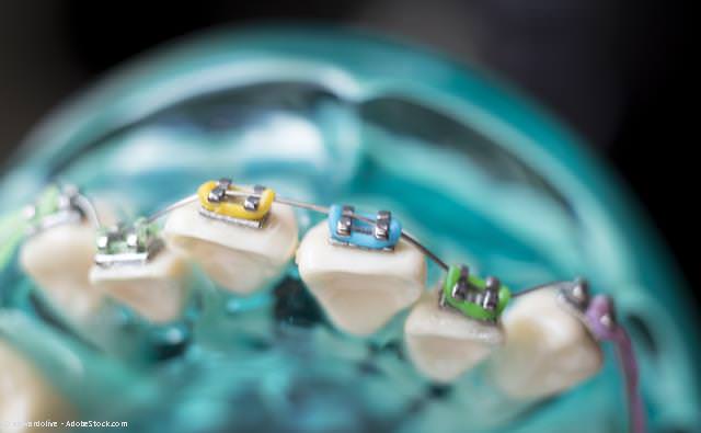 Detailansicht Brackets und Drahtbogen. Der elastische Draht dient der Ausformung des Zahnbogens. Detailansicht Brackets und Drahtbogen. Der elastische Draht dient der Ausformung des Zahnbogens.