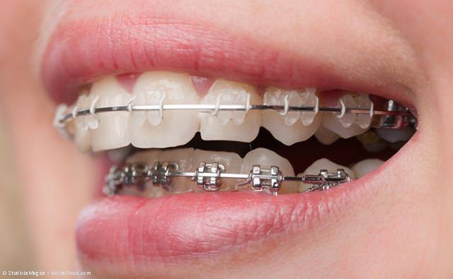 Feste Zahnspangen mit transparenten Brackets (oben) und aus Metall (unten) Feste Zahnspangen mit transparenten Brackets (oben) und aus Metall (unten)
