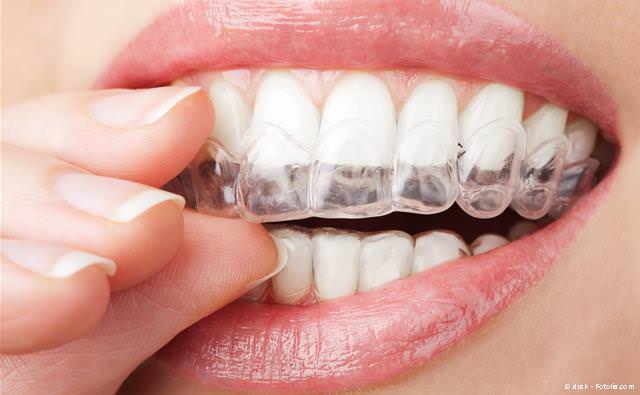 Aligner für unsichtbare Zahnregulierung Aligner für unsichtbare Zahnregulierung