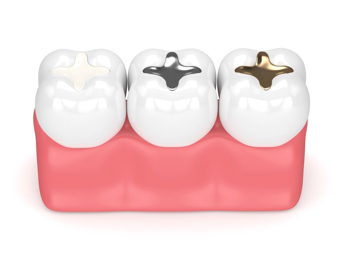 Tooth Fillings — 3D Model Of Tooth-Colored Fillings in Tukwila, WA Tooth Fillings — 3D Model Of Tooth-Colored Fillings in Tukwila, WA