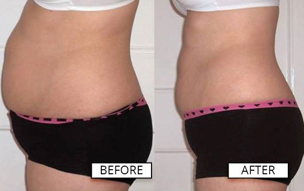 Laser-Like Lipo treatment