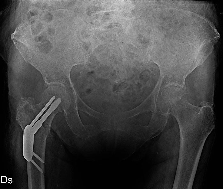 radiografia bacino