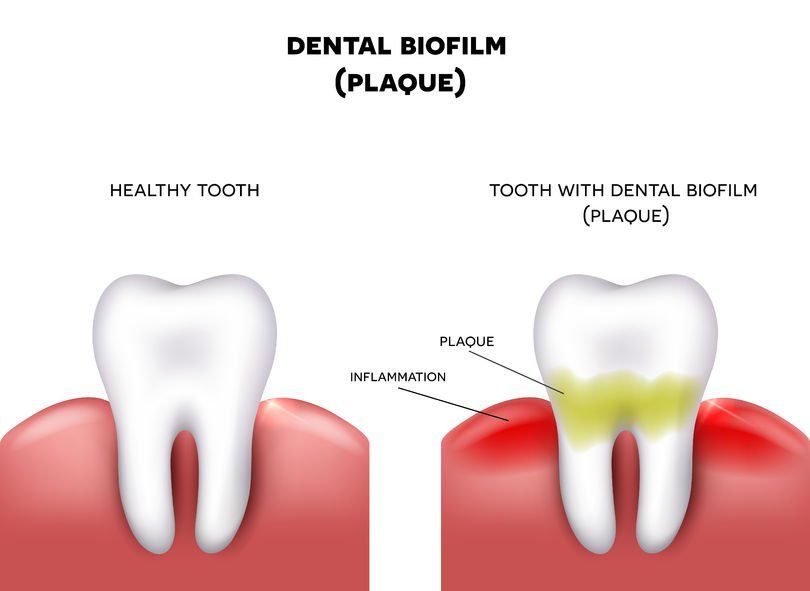 Are Your Gums In Trouble