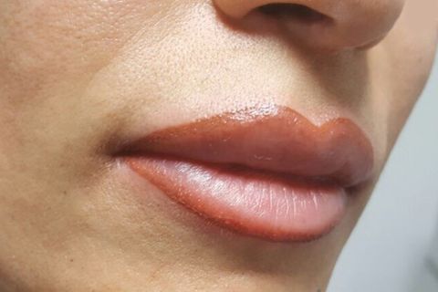 hair removal