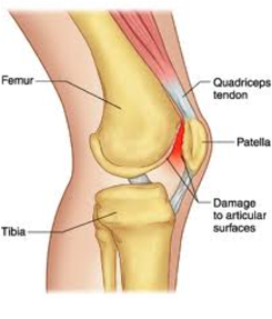 Chondromalacie patellae
