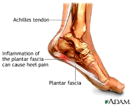 Fasciitis Plantaris