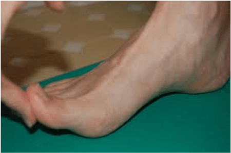 Hallux limitus