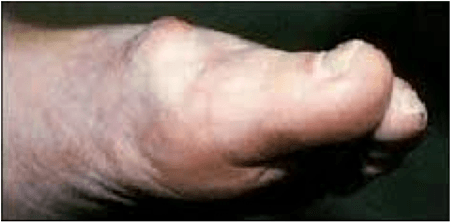 Hallux rigidus