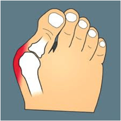 Hallux (abducto) valgus