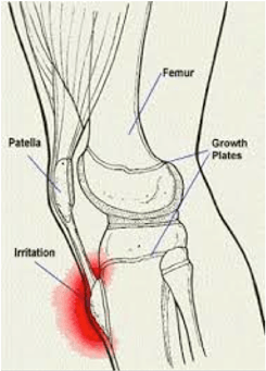 Osgood-Schlatter