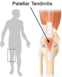 Patellapeestendinitis