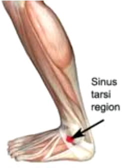 Sinus tarsi syndroom