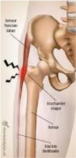 Slijmbeursontsteking aan de heup/bursitis trochanterica