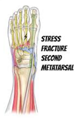 Stressfractuur