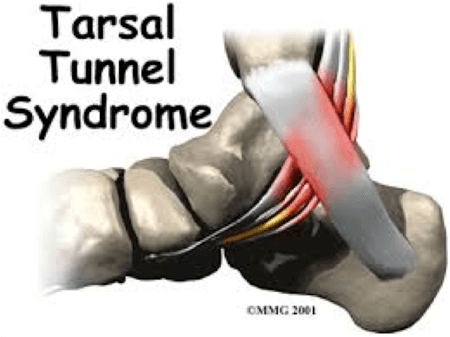 Tarsaal tunnel syndroom