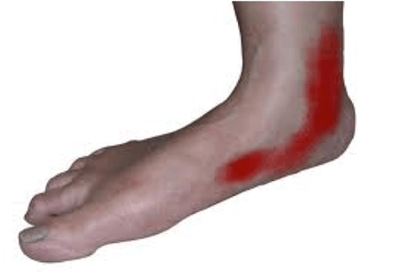 Tibialis Posterior Pees Disfunctie