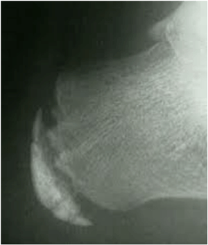 Ziekte van Sever of calcaneale apophysitis