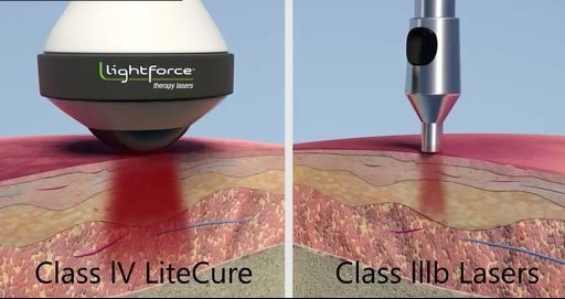 Class IV and Class III lasers - laser therapy in Lynnwood, WA Class IV and Class III lasers - laser therapy in Lynnwood, WA