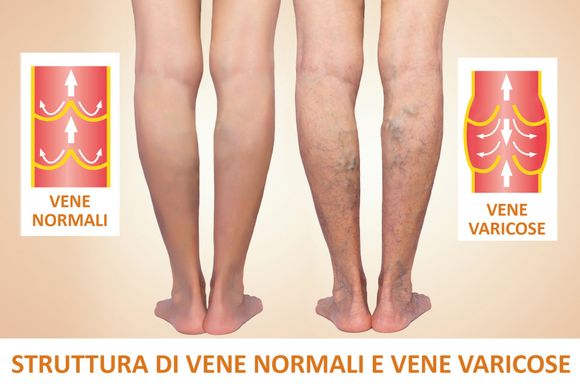 struttura delle vene varicose