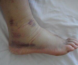 Ankle Sprain — Foot surgery in Tampa, FL