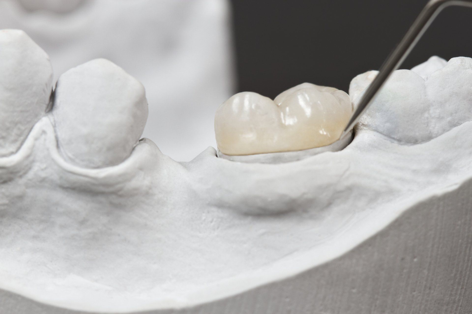 A dental crown being placed on a model tooth by tweezers in a dental setting.