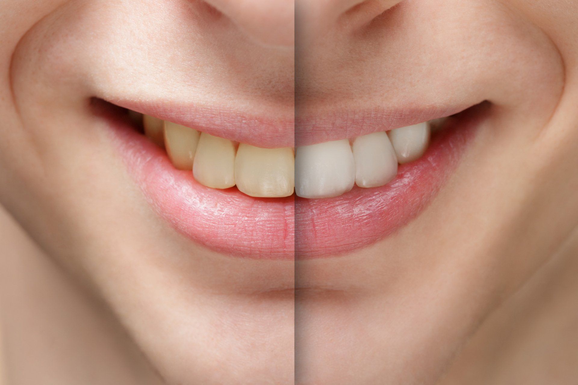 A smiling person's teeth, one half stained and the other half whitened, showcasing teeth whitening.