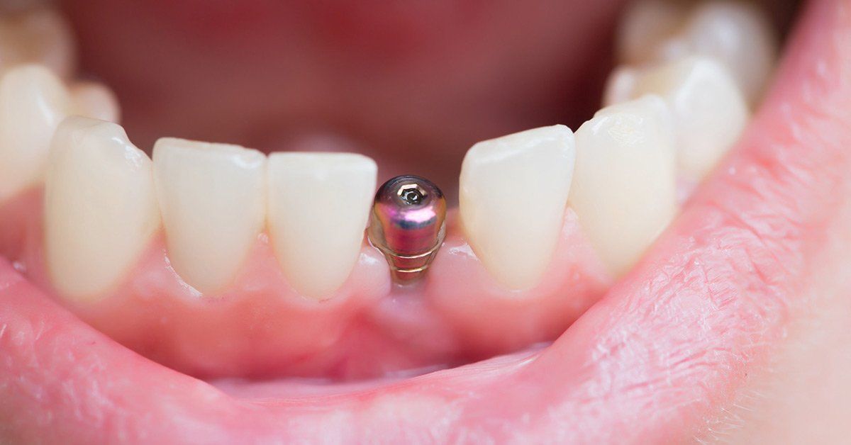 Open mouth with a dental implant in the center of the lower teeth.