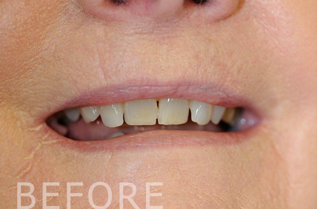 Close-up of a person’s mouth showing teeth with a small gap, labeled “BEFORE.”