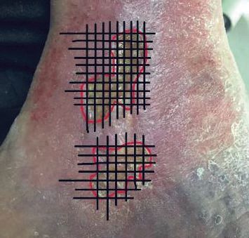 impieghi del laser in podologia