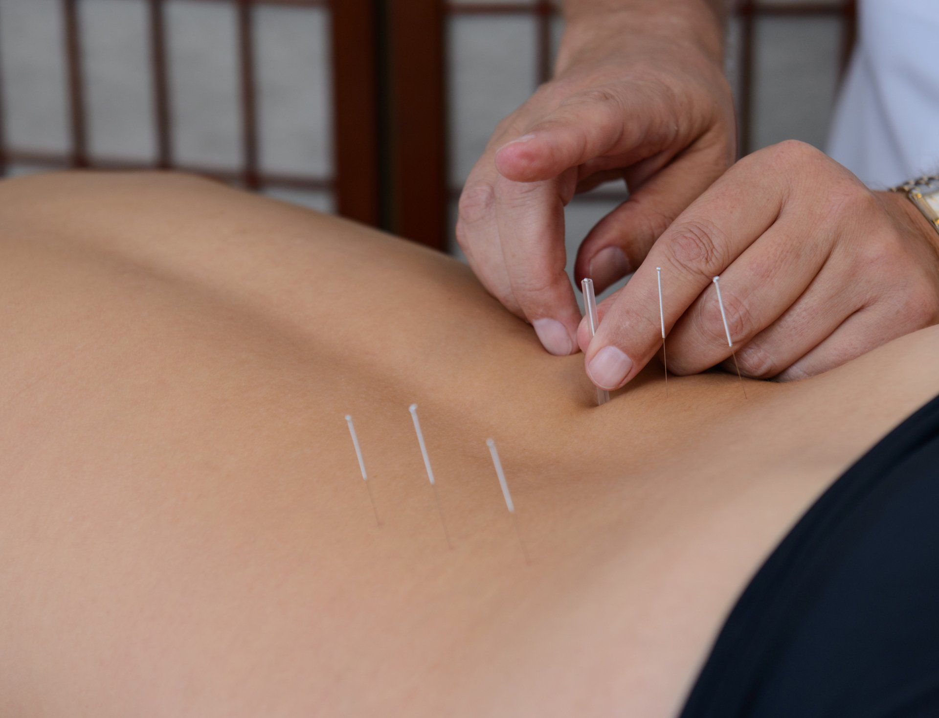 Acupuncture Birmingham Acupuncture Birmingham