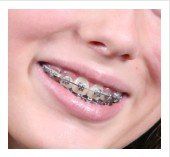 braces