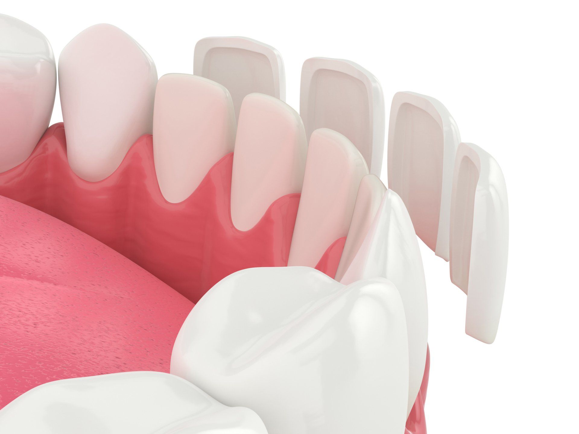 Lower Jaw with Veneers — Charlottesville, VA — William Grupp Dentistry